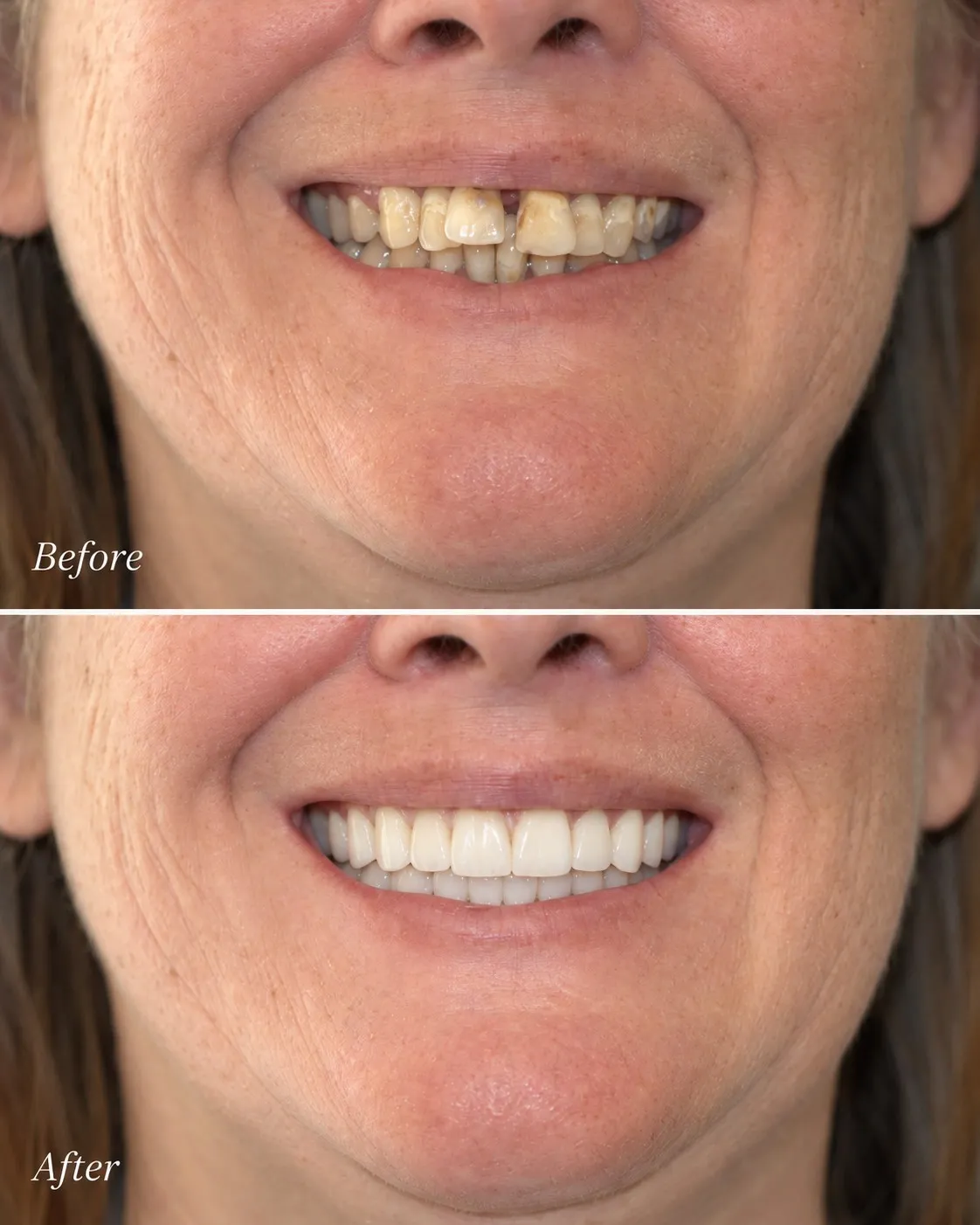 Actual Little Mountain Dentistry patient smile before treatment