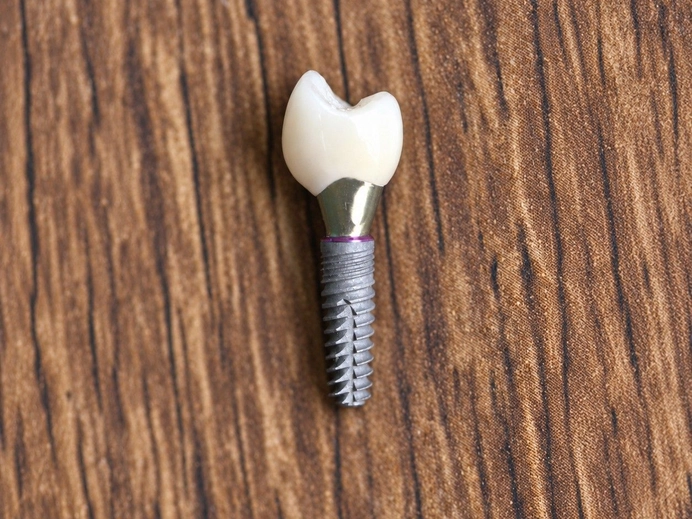 Dental Implants